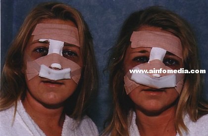 [新聞] 雙胞胎姊妹形影不離　整鼻隆乳也要一起